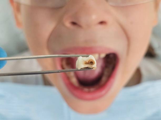 Best Emergency Treatment for Toothache in Gordonsville, VA